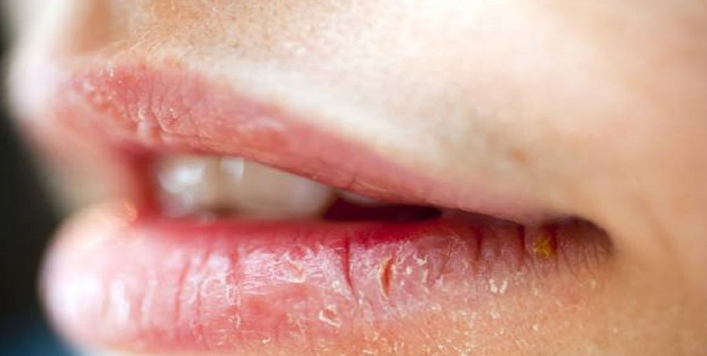 چرا گوشه لب‌ها ترک می‌خورد؟