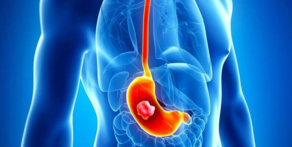 درمان زخم معده با مصرف چند خوراکی مفید